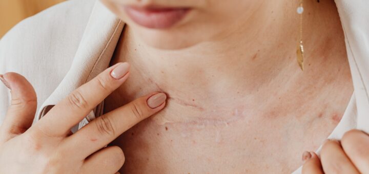 Quel remède naturel pour la cicatrisation